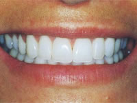 In-Ceram Zirconia Crown and Bridge